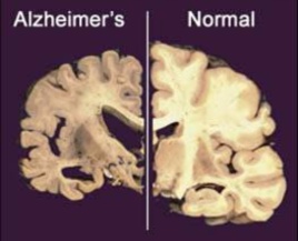 alzheimer brain