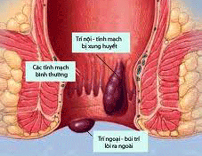 benhtri 1